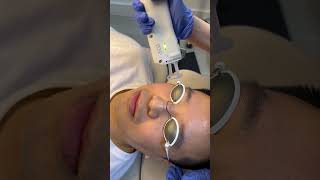 Laser facialLaser Genesis with Lutronic’s Clarity II [upl. by Adnov]