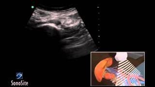 How To Abdominal Aorta Ultrasound 3D Video [upl. by Anaejer]