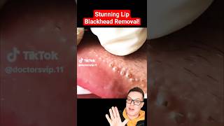 Crazy Painful BLACKHEAD REMOVAL AROUND LIPS  Super Satisfying shorts [upl. by Constance643]