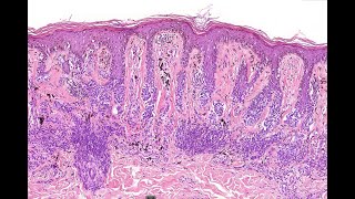 Dysplastic nevus re visited 2024 McKee [upl. by Remos]