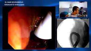 ercp for sems obstruction [upl. by Sou]