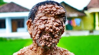 Trypophobia Lovers  5 Weird Skin Conditions [upl. by Atiekahs65]