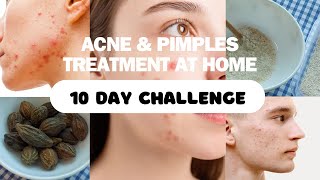 Acne amp Pimples Treatment At Home The Best Medicine and Face Packs for Acne 10 Day Challenge [upl. by Caryn]