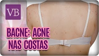 Bacne Acne nas Costas  Você Bonita 260917 [upl. by Assilaj]