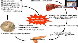 Refeeding Syndrome RFS Prof R K Singh Emergency Medicine SGPGI [upl. by Seleta]