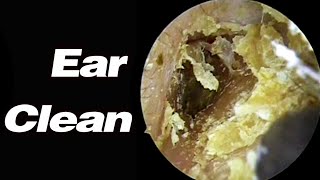 Ear Picking Its Been So Long Since Ive Cleaned It Out That The Earwax Is Getting Infected In There [upl. by Landers]