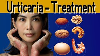 Urticaria symptoms causes treatment and prevention [upl. by Hnilym]