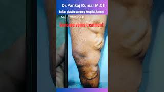 Best varicose veins treatment Laser treatment of varicose veinsvaricose veins treatment in Ranchi [upl. by Ecinehs642]