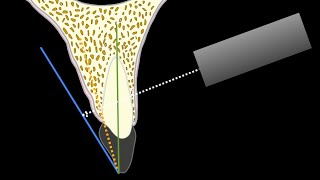 Paralleling technique amp Bisecting angle technique  Periapical radiography [upl. by Millicent]