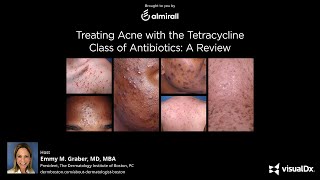 Treating Acne with the Tetracycline Class of Antibiotics A Review [upl. by Aleakim]