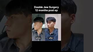 12 months post op Lantern Jaw Double Jaw Surgery post op [upl. by Zoller]