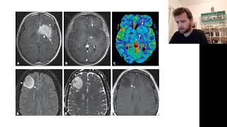 Oligodendroglioma  Resuminho rapidão [upl. by Lerner]