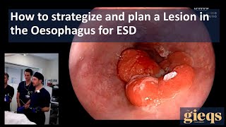 How to strategize and plan a Lesion in the Oesophagus for ESD [upl. by Isle876]