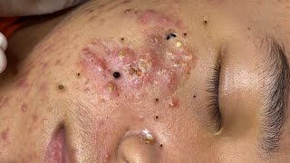 Big Cystic Acne Blackheads Extraction Blackheads amp Milia Whiteheads Removal Pimple Popping  65490 [upl. by Eiramenna746]