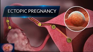 Ectopic Pregnancy  What Causes Ectopic Pregnancy  Ectopic Pregnancy Animation [upl. by Nallaf]