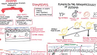 Asthma  signs and symptoms pathophysiology [upl. by Yve519]