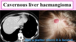 cavernous liver haemangioma [upl. by Eedeed]