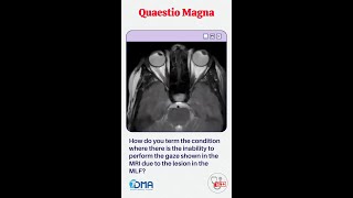 INTERNUCLEAR OPHTHALMOPLEGIA  OSPE amp OSCE  MBBS  NEXT   PLAB  USMLE  DMA [upl. by Tra]