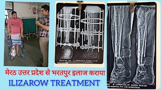 ilizarovsurgery मेरठ उत्तर प्रदेश से भरतपुर इलाज कराने आया मरीज tibiafibulafracture infection [upl. by Ynetsed]