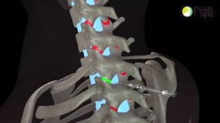 Cervical facet joint injections under Xray guidance [upl. by Amirak]