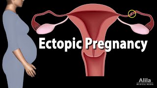 Ectopic Pregnancy Animation [upl. by Sherurd]