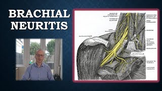 Brachial Neuritis  Parsonage Turner Syndrome [upl. by Auqenaj]