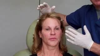 InstantLift with PDO threads with Dr Janowski [upl. by Cyrus]