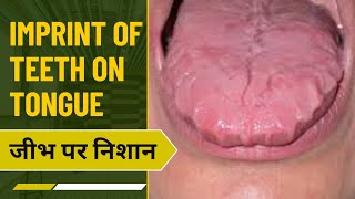 Imprint of teeth on Tongue  scalloped Tongue  जीभ पर दात के निशान  stress  vitamin  smoking [upl. by Airretal]