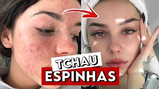 COMO ACABAR com as ESPINHAS RÁPIDO  Dicas para ELIMINAR a ACNE GASTANDO POUCO [upl. by Atalayah]