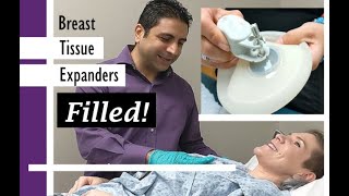 Breast Tissue Expanders How They Fill Work and Feel [upl. by Nanam]