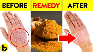 13 Remedies To Treat Psoriatic Arthritis Naturally [upl. by Meikah]