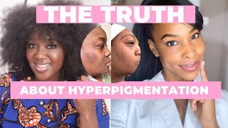 The TRUTH about Hyperpigmentation and Black Skin [upl. by Couhp]