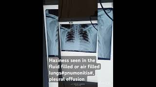 cxr radiological ground glass opacity or haziness seen in condition like pneumonitis or plueral e [upl. by Ebsen]