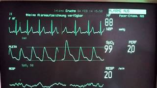 Ventricular Extrasystoles [upl. by Eaneg]