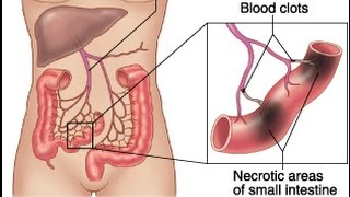 Mesenteric Ischemia [upl. by Ahtaela]