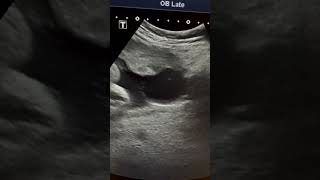 Placental cyst Ultrasound in 3rd trimester pregnancy ARDMD sonography [upl. by Naillik]