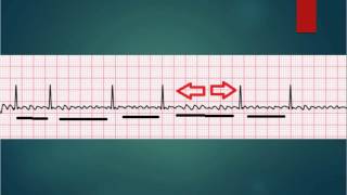 ECG Basics A fib [upl. by Deelaw203]