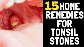 15 home remedies for tonsil stones [upl. by Hardi]