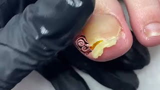 TRIMMING fungal Toenail with onycholysis [upl. by Nivak896]