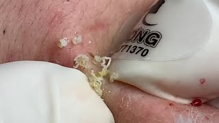 Acne Treatment Huong Da Nang membership 012 part 1   2023 [upl. by Cappello]