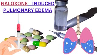 Naloxone induced pulmonary edema [upl. by Vivle146]