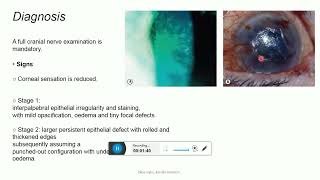 Neurotrophic keratopathy [upl. by Millian285]