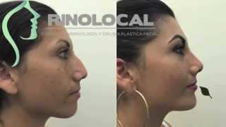 RINOPLASTIA CON MENTOPLASTIA BAJO ANESTESIA LOCAL RINOLOCAL [upl. by Ahsenav]