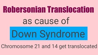 Robertsonian translocation as cause of Down syndrome downsyndromerobertsoniantranslocation [upl. by Kori]