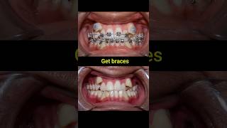 Braces 30 months transformation braces orthodontist dentist dental [upl. by Ahsirak]