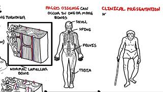 Pagets Disease of the bone [upl. by Pedrick]