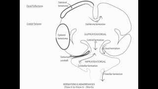 Herniation amp Intracranial Hemorrhage  Draw it to Know it Neuroanatomy [upl. by Lily200]