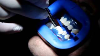 How is Laser Teeth Whitening Done  Teeth whitening in Toronto [upl. by Nithsa865]