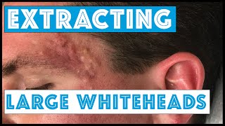 Acne Vulgaris and Extracting large Whiteheads  Part 1 [upl. by Namron]