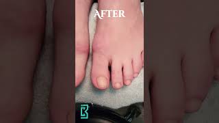 LCN Barefoot Toenail Restoration [upl. by Damal]